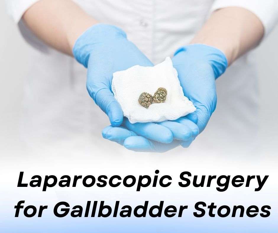 Laparoscopic Surgery for Gallbladder Stones