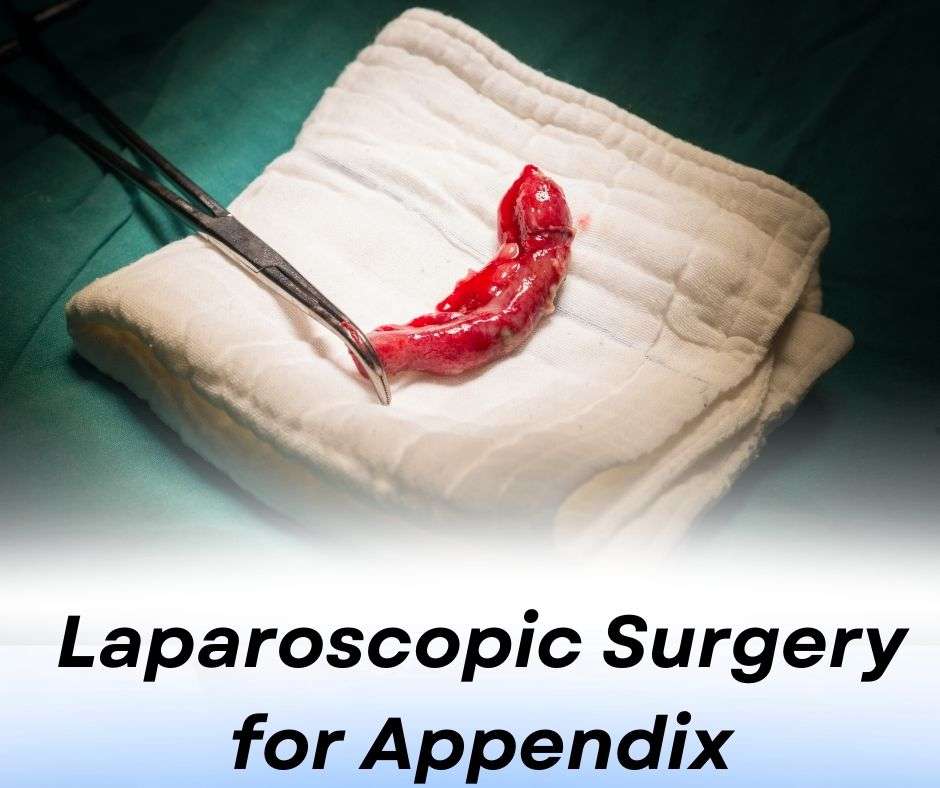 Laparoscopic Surgery for Appendix