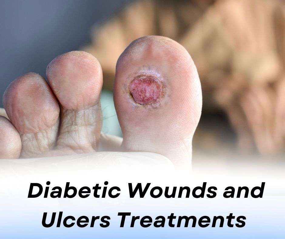 Diabetic Wounds and Ulcers